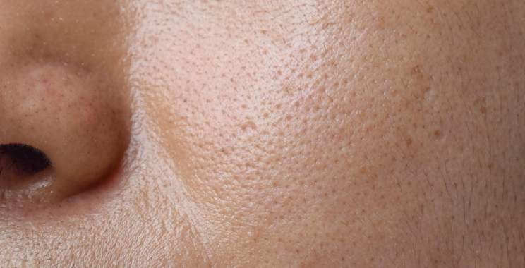 فیلامنت‌های چربی پوست